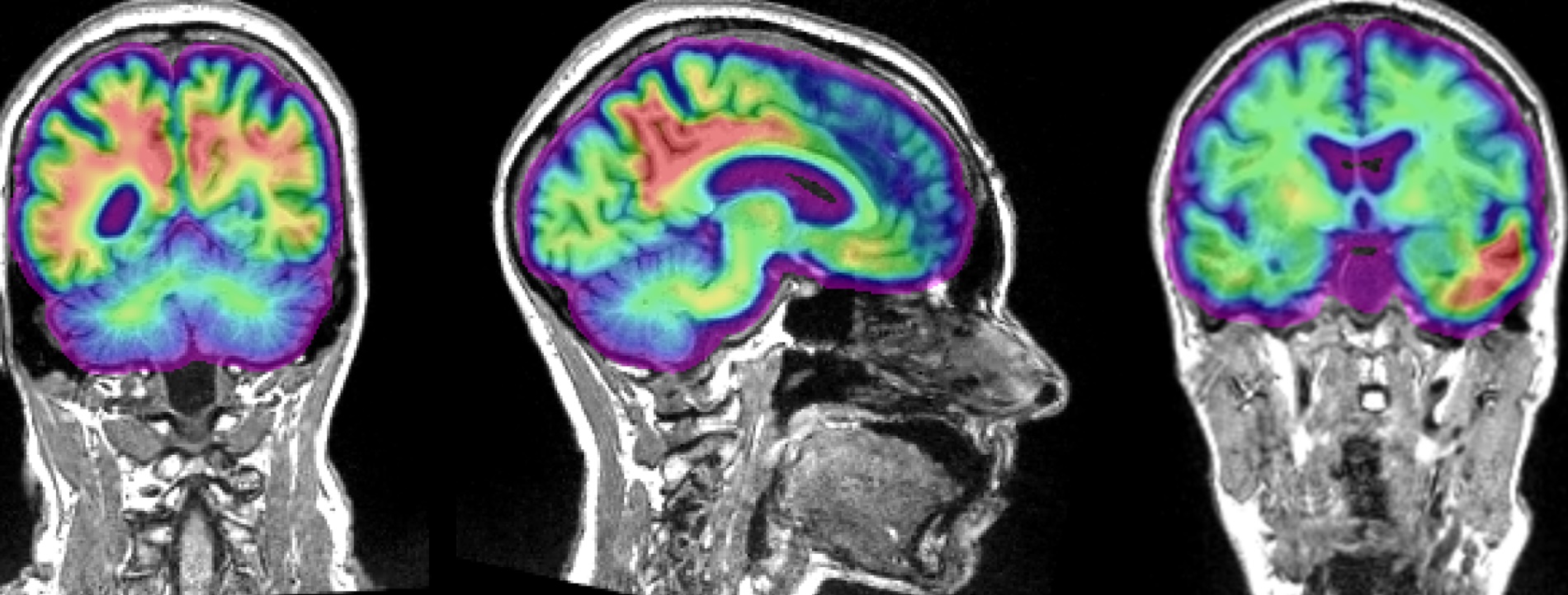 Your Donations Are Fueling New Treatments for Brain Tumours